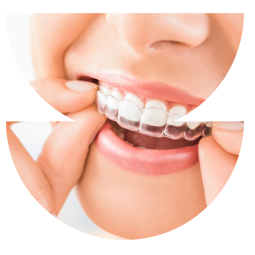 invisalign
